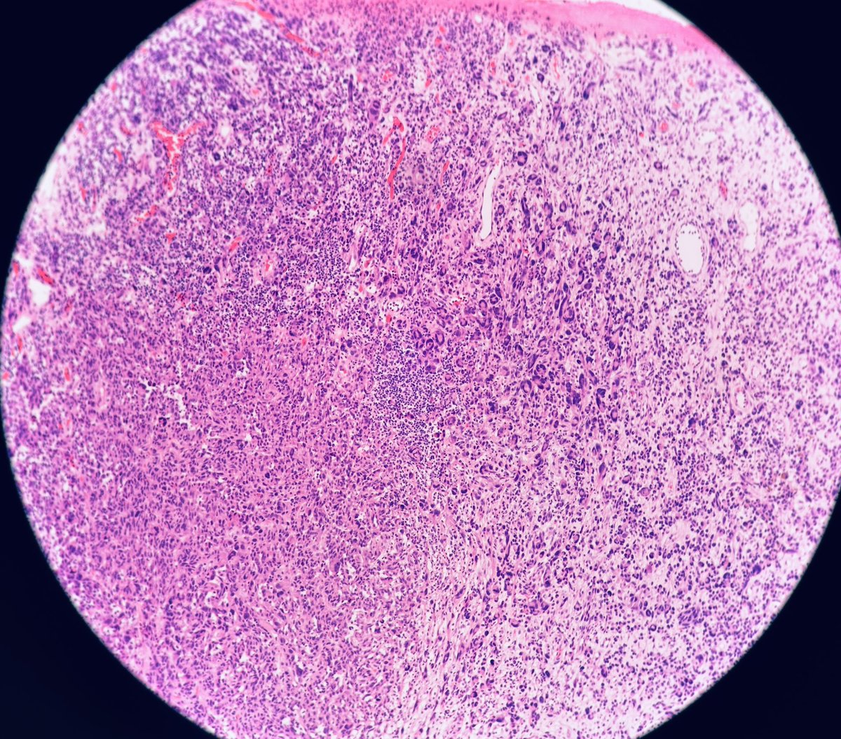 HENRYY_MD's tweet photo. Another melanoma comes across my scope … see, they come in all kinds of shapes and forms, but they are all BAD! This one I guess show dedifferentiation ( sarcomatous changes) , lost melanocytic markers in deeper components ( lost PRAME too)
#dempath
@TristanRutland7 @PIorfino https://t.co/e24Z3PXTCw