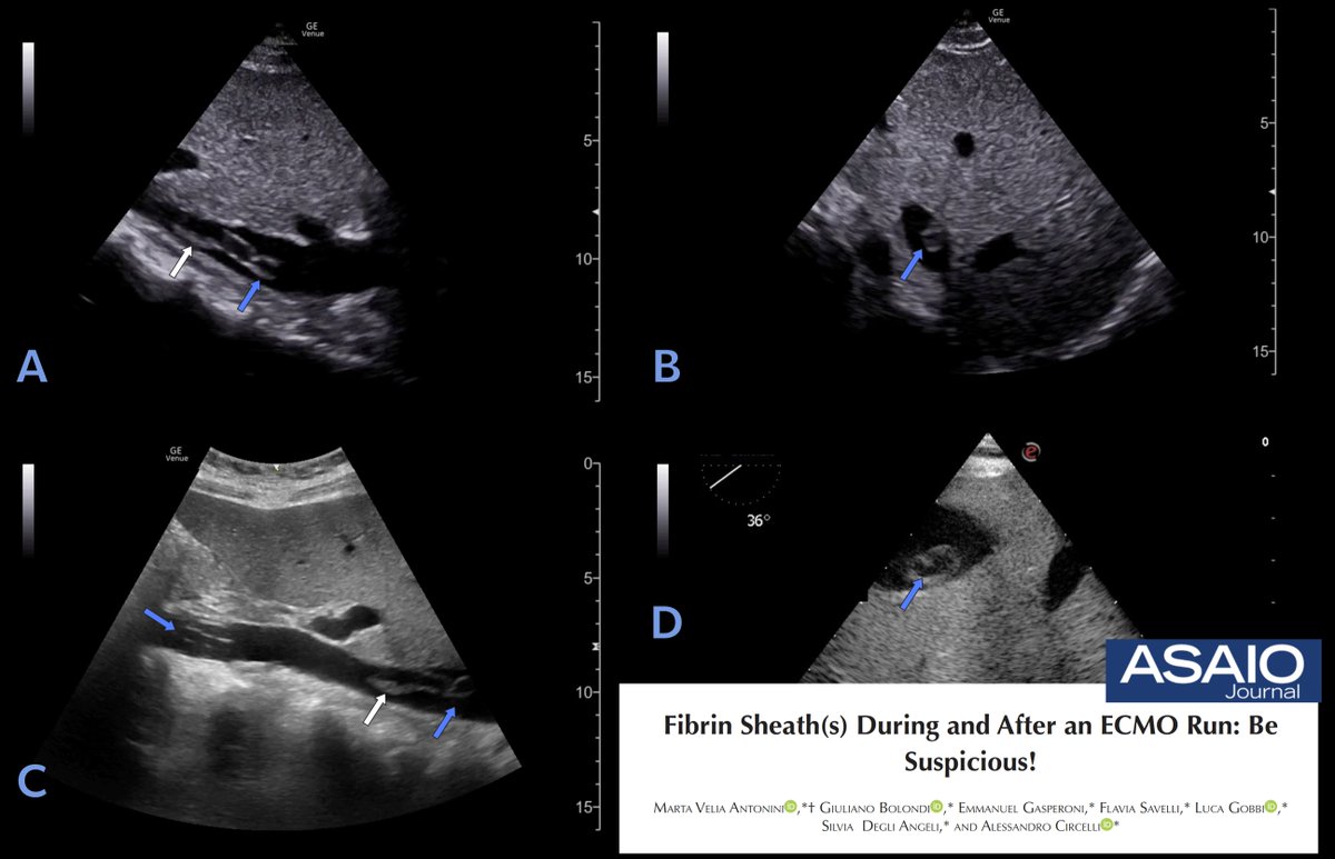 M Velia Antonini (@foamecmo) on Twitter photo Fibrin sheath(s) during & after #ECMO run
🩸 white deposits on ML
⚙️ high ML resistances
🩸 severe, persistent (& unexplained) drainage insufficiency
Be suspicious & monitor for complications also after decannulation...
Just out #FOAMcc on <a href="/asaiojournal/">asaiojournal</a>
🔓 bit.ly/43AeJa2 Fibrin sheath(s) during & after #ECMO run
🩸 white deposits on ML
⚙️ high ML resistances
🩸 severe, persistent (& unexplained) drainage insufficiency
Be suspicious & monitor for complications also after decannulation...
Just out #FOAMcc on <a href="/asaiojournal/">asaiojournal</a>
🔓 bit.ly/43AeJa2