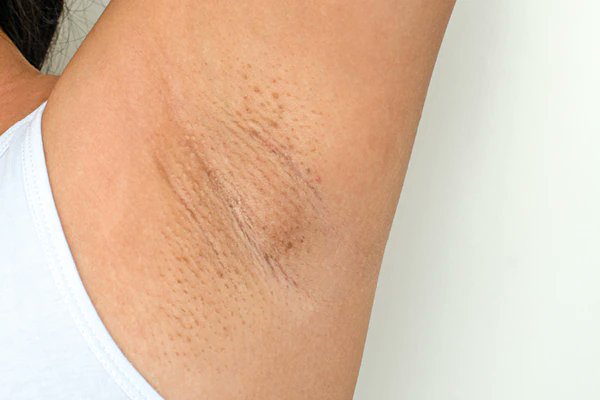 How to Prevent Ingrown Hairs After Waxing  The Skin Games