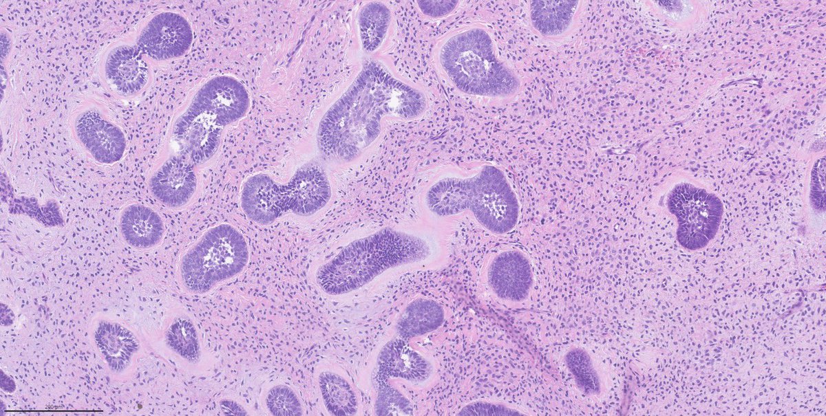 🔬32 yo F, mandibular tumor:
Diagnostic and minithread for this classic entity in the comments bellow 🔜
#PathTwitter #headandneck #entpath
@HeadNeckPathol @HeadandNeckPath @PathDocBoston @Patholwalker