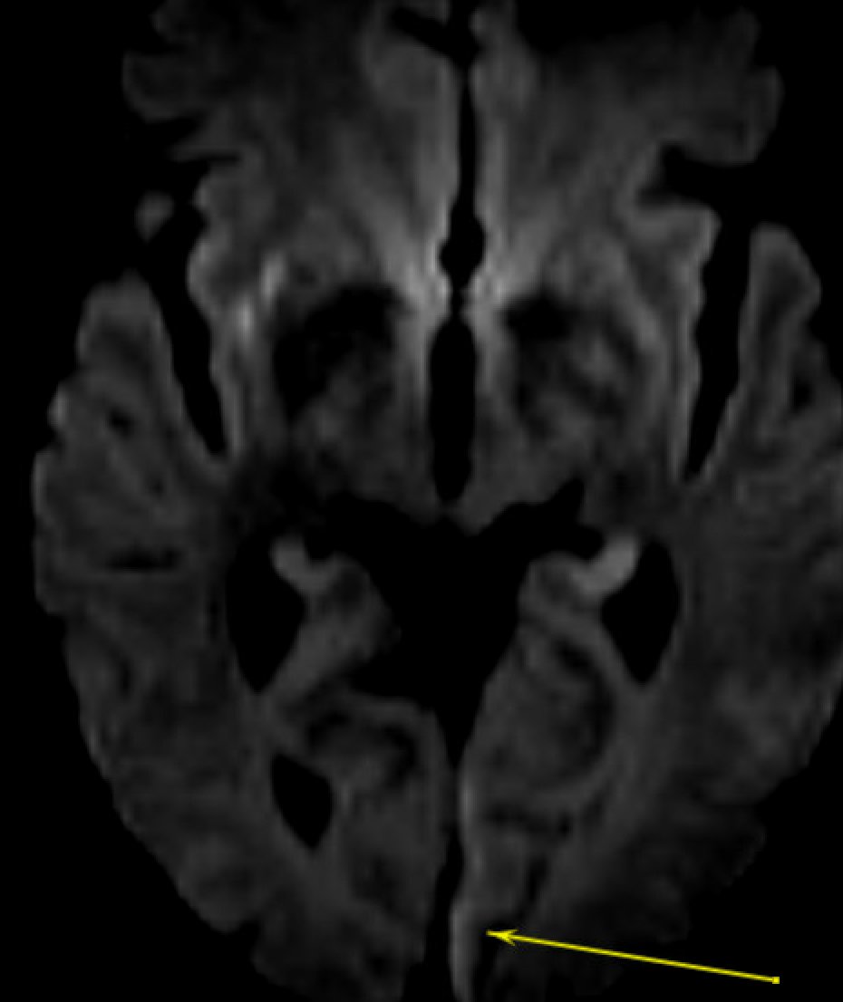 Middle aged person with confusion. DWI pattern seizure or stroke? (yes it's really there)