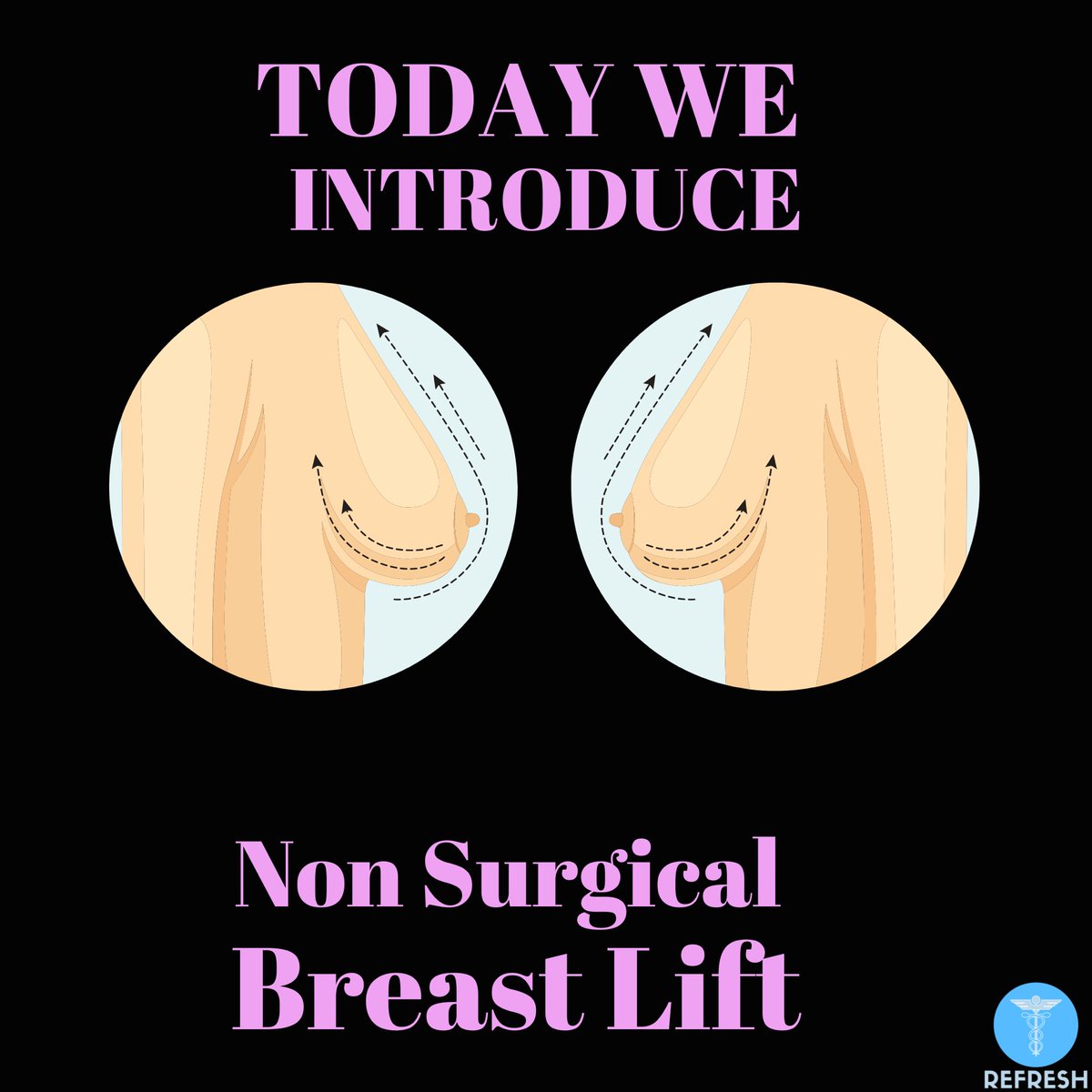 DRFRESHPRP's tweet image. &quot;Want a subtle breast lift without surgery? Aptos threads might be the solution! They involve inserting threads through small incisions, and the results can last up to 2 years. Check out the benefits and FAQs, and book a free consultation with Dr. Zama @RefreshLIFT