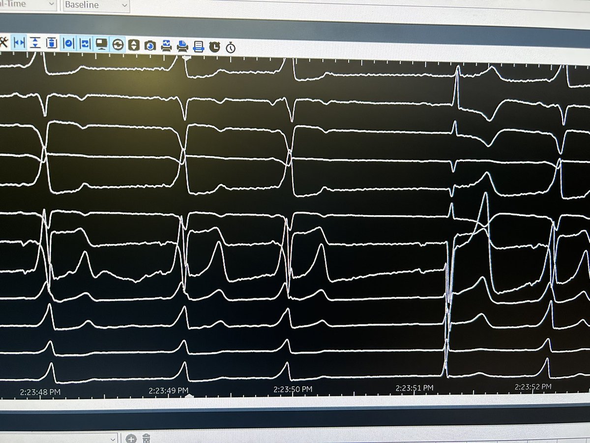 Travis Richardson (@ep_travis) on Twitter photo What’s the physiology here #EPeeps, fellows first. <a href="/True_EP/">William H. Sauer, MD</a> could probably help you out. Ok now time to 🔥 What’s the physiology here #EPeeps, fellows first. <a href="/True_EP/">William H. Sauer, MD</a> could probably help you out. Ok now time to 🔥