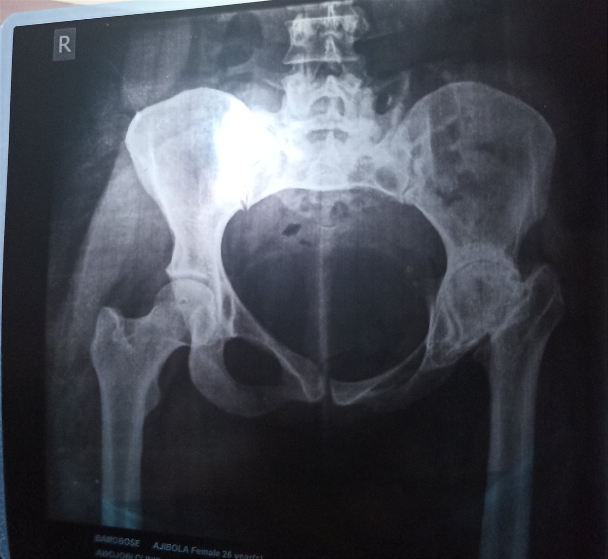 conflict_chick's tweet photo. Hello Everyone,

I'm grateful to everyone that reached out during these trying times. I want to inform everyone that the hip replacement surgery was successful and I'm recovering fast. It's a painful process.

I'm grateful for the support always. Pray for me, please.Thank you https://t.co/6sHsfTiX7C