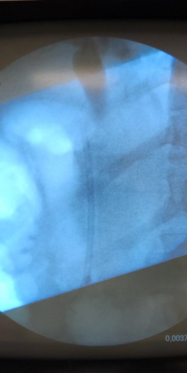 GIDrDon's tweet image. And when the scope reduction is tough, you make it work because during a #cholangitis case, we ain&apos;t got time to muck around #GITwitter #MedTwitter #ERCP #interventionalgi #thisiswhatwedo