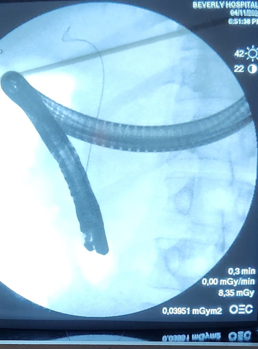GIDrDon's tweet image. And when the scope reduction is tough, you make it work because during a #cholangitis case, we ain&apos;t got time to muck around #GITwitter #MedTwitter #ERCP #interventionalgi #thisiswhatwedo