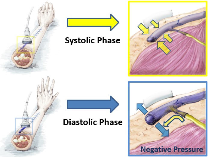 PARjournal's tweet photo. #Lymphedema #Supermicrosurgery #Anastomosis
🎉🎉Excited to share Dr. Yukio Seki's team's valuable Review "Functional lymphaticovenular anastomosis for peripheral lymphedema: incision selection methods with muscle pumping"
🔗https://t.co/VtrX6RpfBA
🔖https://t.co/gwB9gwGtgW https://t.co/N60q6dSY5A