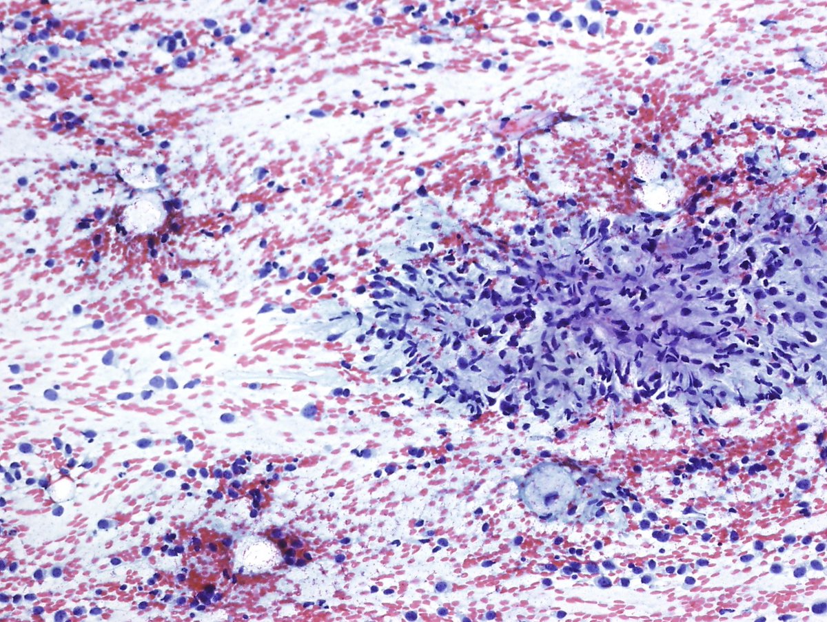 One of my personal best examples of myxoid liposarcoma on FNA. Hope you enjoy it 🔬📚🧐🤞
#PathResidents <a href="/SECitologia/">Sociedad Española de Citología</a> <a href="/CytologyEFCS/">EFCS</a> <a href="/SEAP_IAP/">SEAP-IAP</a>