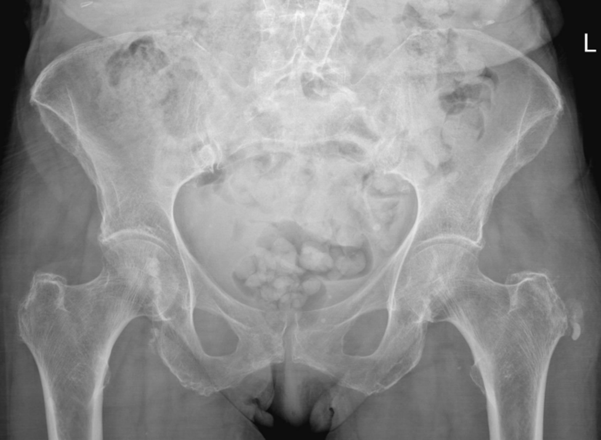 mskteachingroom's tweet photo. Patient presenting to 🏥 with excruciating acute left hip pain. 

What is the pain generator in this case? 

MR images coming up later 🧲

#radfellow #radiologyfellow #radiologyresident #learningradiology #radres #mskrad #radtwitter #radiology #transformingradiology #mri https://t.co/v9dmrBbh56