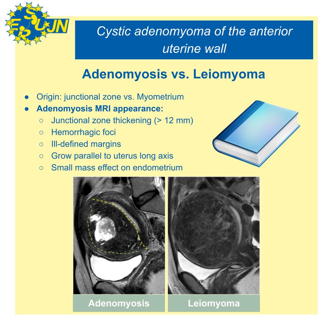 You got it! It was a cystic adenomyoma! As it was not easy, here it goes some teaching points from @lrusso_md  to diferenciate with the leiomyoma. Thank you all fot paticipating, see you tomorrow in TT! 
#GUimaging #mri #WomanImaging