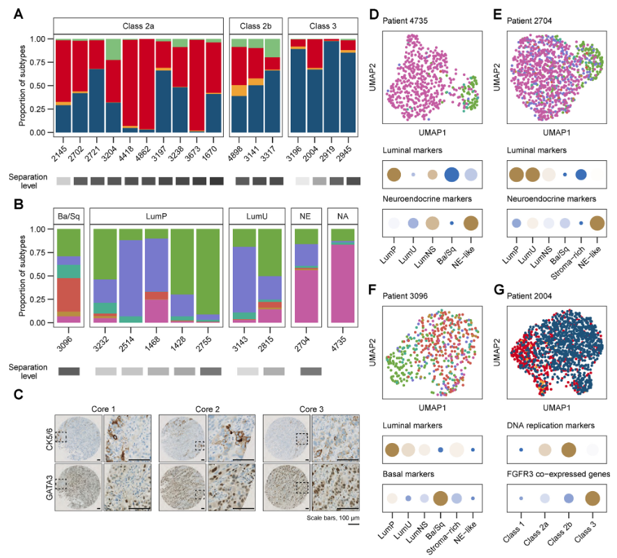 Time to rethink bulk tumor classification systems? Our work on intra-tumor subtype heterogeneity in bladder cancer using single-nucleus RNA-sequencing is now out in @EurUrolOpen: doi.org/10.1016/j.euro… @LDyrskjot @SofieSchmoekel @IverNordentoft @moma_dk