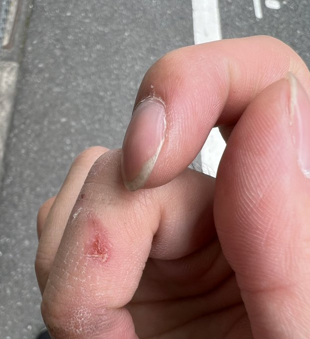 皮膚溶けちゃった 