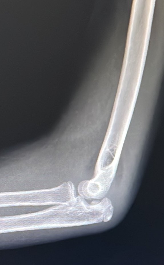 Bipin Theruvil FRCS (T&O),FRCS (Ed&Glasg),MS AIIMS tweet media