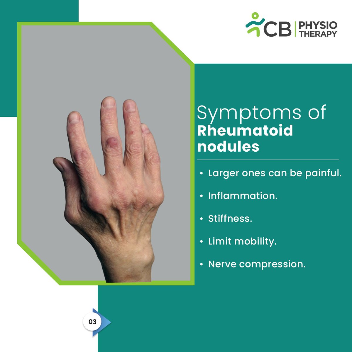 CBPhysioAH's tweet photo. 📷Are you living with rheumatoid arthritis? You may be familiar with rheumatoid nodules, small lumps that can develop under the skin.

📷These nodules can cause discomfort and affect joint function. Luckily, Physiotherapy treatment can help manage them.

#rheumatoidarthritis https://t.co/12LuJSe41f