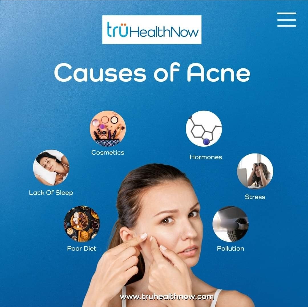 Causes of Acne

1. Cosmetics
2. Lack of Sleep
3. Poor Diet
4. Harmones
5. Stress
6. Pollution

#truhealthnow #acne #AcneCauses #ClearSkin #Skincare #GlowingSkin #AcneSolutions #SkinCareRoutine