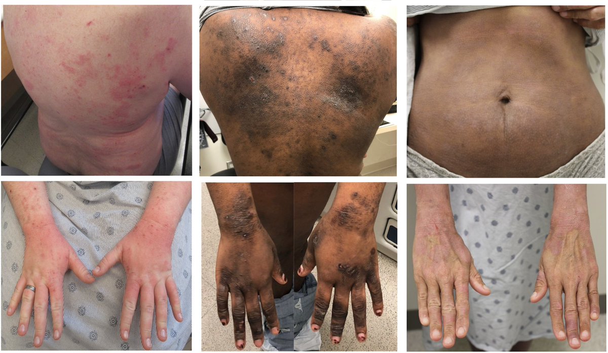 drshawnkwatra's tweet photo. Excited to share our team’s latest work led by @waleedadawi96 on the various presentations of #eczema in @SkinOfColor patients https://t.co/WqhchiSxds. Looking forward to keep advocating for #diversity in new leadership roles @SkinOfColor &amp; @nationaleczema #dermtwitter https://t.co/wdRw92de1X