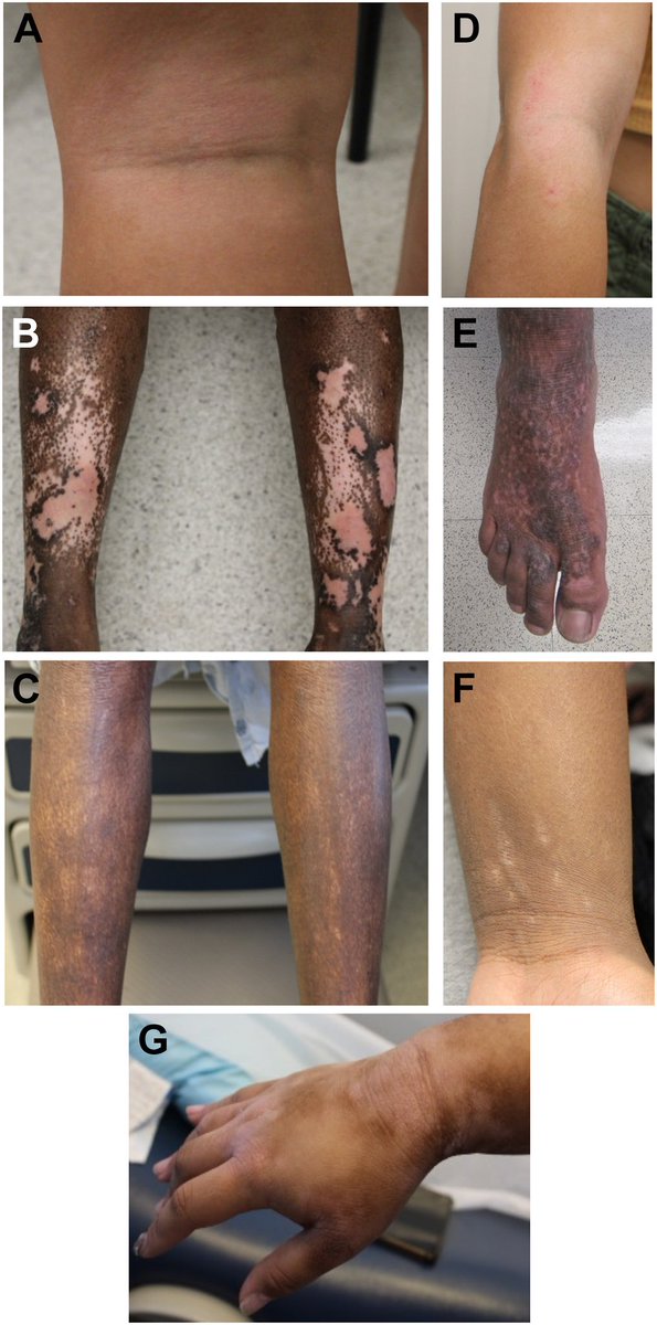 drshawnkwatra's tweet photo. Excited to share our team’s latest work led by @waleedadawi96 on the various presentations of #eczema in @SkinOfColor patients https://t.co/WqhchiSxds. Looking forward to keep advocating for #diversity in new leadership roles @SkinOfColor &amp; @nationaleczema #dermtwitter https://t.co/wdRw92de1X
