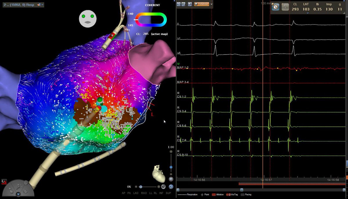 ArritmiasHUA's tweet photo. Macroreentrada peri-cicatriz en cara anterior de AI. Final de la taquicardia con aplicación https://t.co/WUmmv9CWWv