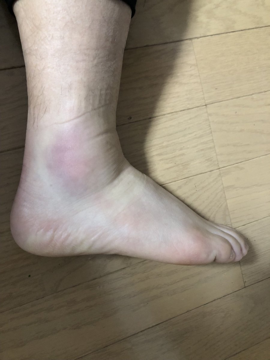 angokoro's tweet photo. 足首捻ってしまいました
汚い足ですいません https://t.co/jcwakTj76n
