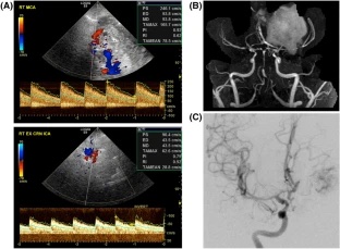 Neurocritical Care (@neurocritcarej) on Twitter photo Harrar et al: Neuromonitoring in Children with Cerebrovascular Disorders
Link: ow.ly/79q750Nw34F
<a href="/neurocritical/">Neurocritical Care Society</a> #NeuroCritCare Harrar et al: Neuromonitoring in Children with Cerebrovascular Disorders
Link: ow.ly/79q750Nw34F
<a href="/neurocritical/">Neurocritical Care Society</a> #NeuroCritCare
