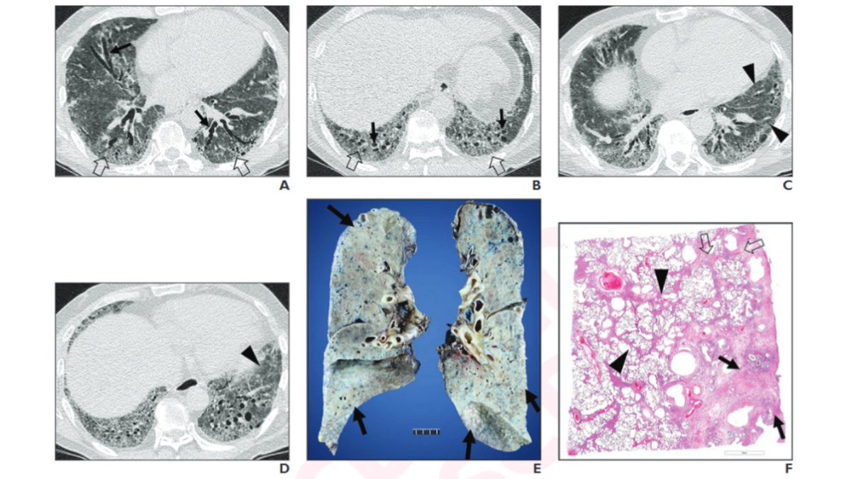 New <a href="/AJR_Radiology/">AJR</a> Accepted Manuscript:

"Imaging of Pulmonary Fibrosis: An Update, From the AJR Special Series on Imaging of Fibrosis"

By Drs Lee, Han, Wada, Hatabu, &amp; team

ajronline.org/doi/abs/10.221…