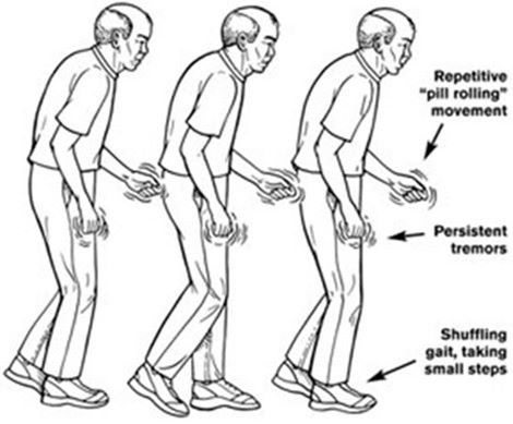 MarlycespedesB's tweet photo. similares a las observadas en la enfermedad de Parkinson y que son manifestaciones todas de una demencia subcortical. Por otro lado, también se puede presentar depresión, ansiedad trastornos de la conducta, trastorno por déficit de atención e hiperactividad. https://t.co/jEVgIztxLZ