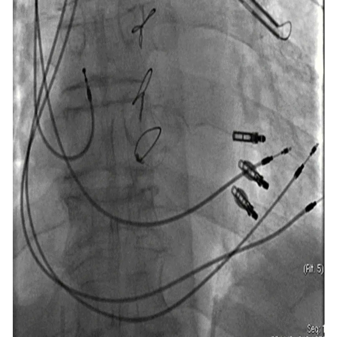 💡🧠ICOT Clinical case of the week🧠

💡 Utilizzo della Cardiac Contractility Modulation e della Mitraclip in paziente con scompenso cardiaco a frazione moderatamente ridotta ed insufficienza mitralica severa 💡

💡 Leggi il caso clinico completo su: 
italiancot.it/2023/04/07/uti…