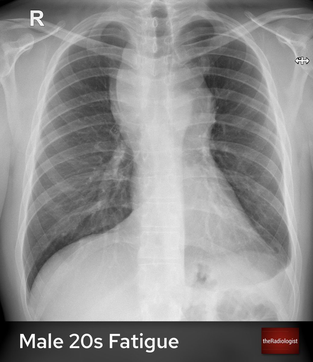 radiologistpage's tweet photo. Male in his 20s presents with fatigue. What does the X-Ray show? https://t.co/2kXib71n6n