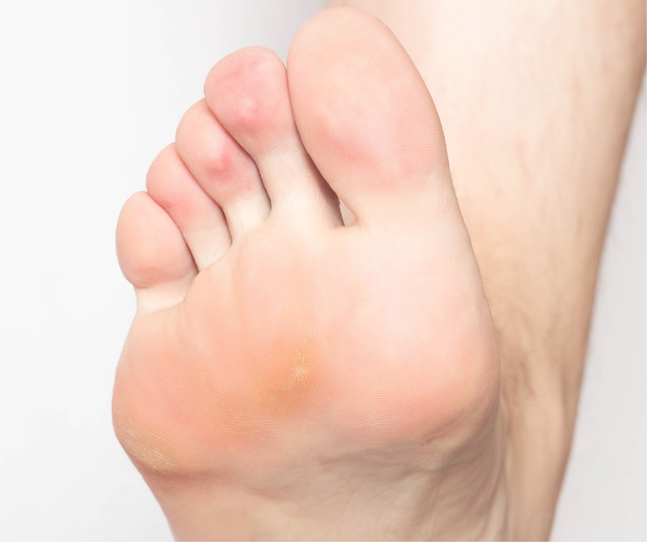 PodCenterNJ's tweet photo. Corns and calluses are common foot issues we see at the Podiatry Center of New Jersey. Considering spring is finally here, you might want to free your feet of these. Find out how to deal with pesky corns and calluses in this week's blog: https://t.co/igj8Gzr43D https://t.co/w8PQRMolXs