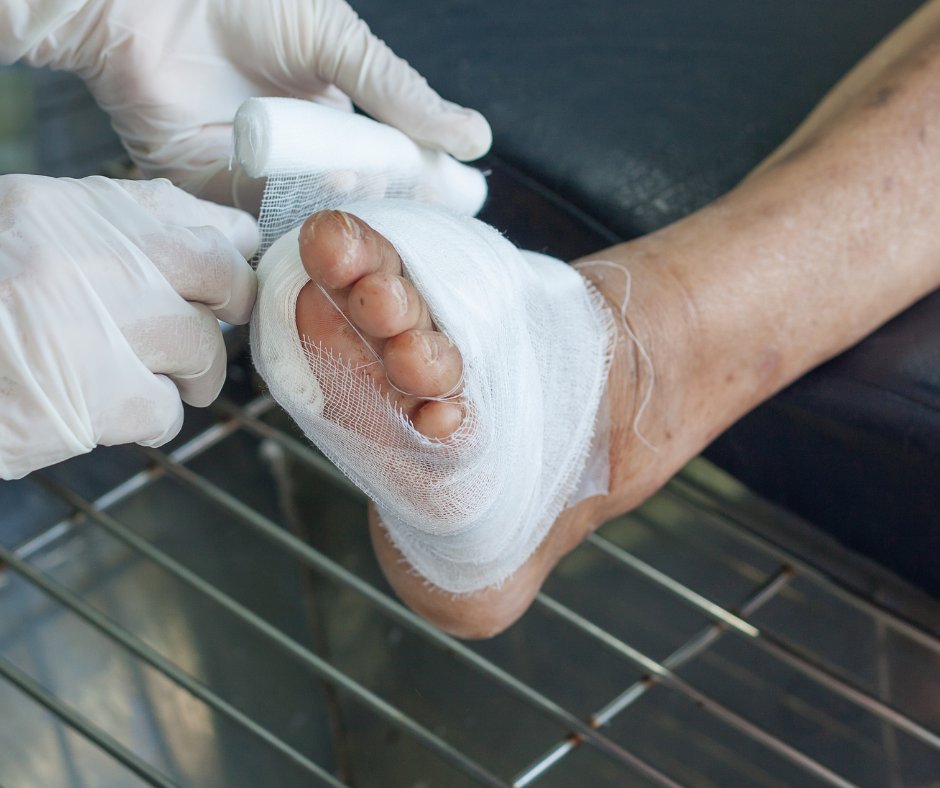 AmarilloFoot's tweet photo. Nerve damage and circulation problems are common in diabetics. As a result, lower limb or foot amputation may be necessary. Learn more about the link between diabetes and amputation in our latest blog: https://t.co/jED3iUl1va https://t.co/UcyQc3H5Ls
