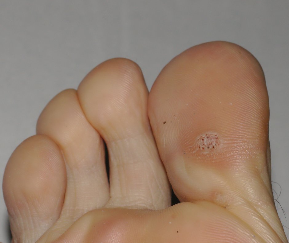 wehapodiatry's tweet photo. Warts aren’t always painful, but they can be difficult to get rid of! Luckily, we offer a quick and painless treatment option for warts with Swift therapy. Visit the link below to learn more, then give us a call! https://t.co/GqMOVqrLeS https://t.co/UrHDLZNMOq
