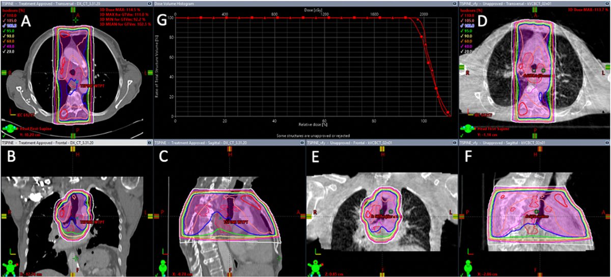 Simulation free radiotherapy (SF-RT) is an emerging treatment paradigm for patients requiring palliative radiotherapy. In this matched cohort study, SF-RT improved time to plan generation compared to CT-simulated radiotherapy. <a href="/JoshuaSchiffMD/">Joshua Schiff</a> @WashURadOnc bit.ly/3Tr7ZVU