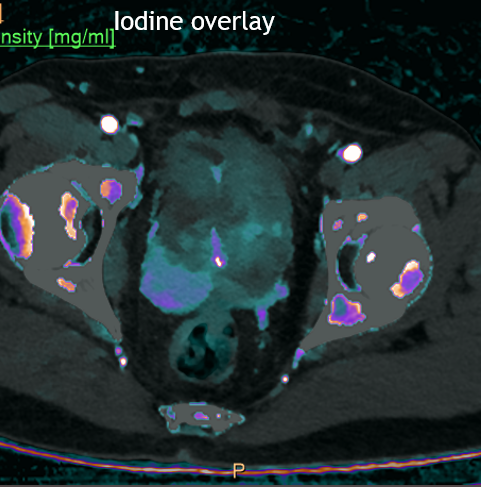 Undiagnosed prostate cancer, so much better seen on #SpectralCT with low keV image and iodine overlay.
Radiologist may be first to raise the possibility of prostate ca, especially on CT scans done from the ED.
#radres #FOAMed