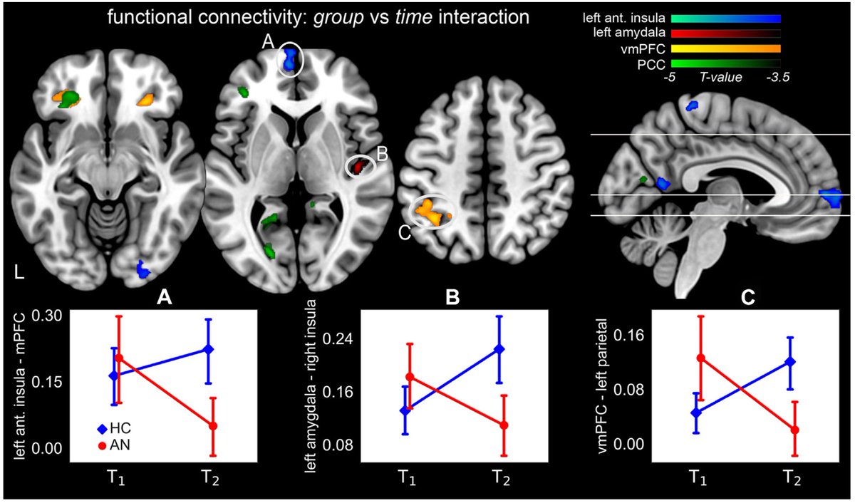 We found that weight-restored AN individuals showed reductions in functional connectivity between central autonomic network brain regions and areas involved in interoceptive representation &amp; visceromotor regulation after adrenergic stimulation relative to healthy comparisons. 2/7