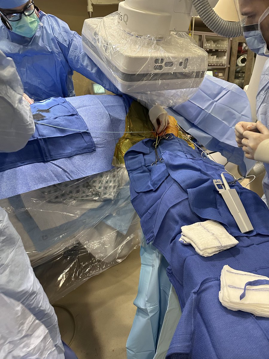 RafayKhanMD's tweet image. Part 2:

Surgical cutdown from left subclavian for pci of ostial lcx to left main. Vascular recommended left subclavian cutdown
(Permission obtained from patient)
#cardiology #coronary #radial #interventional #chip #pci