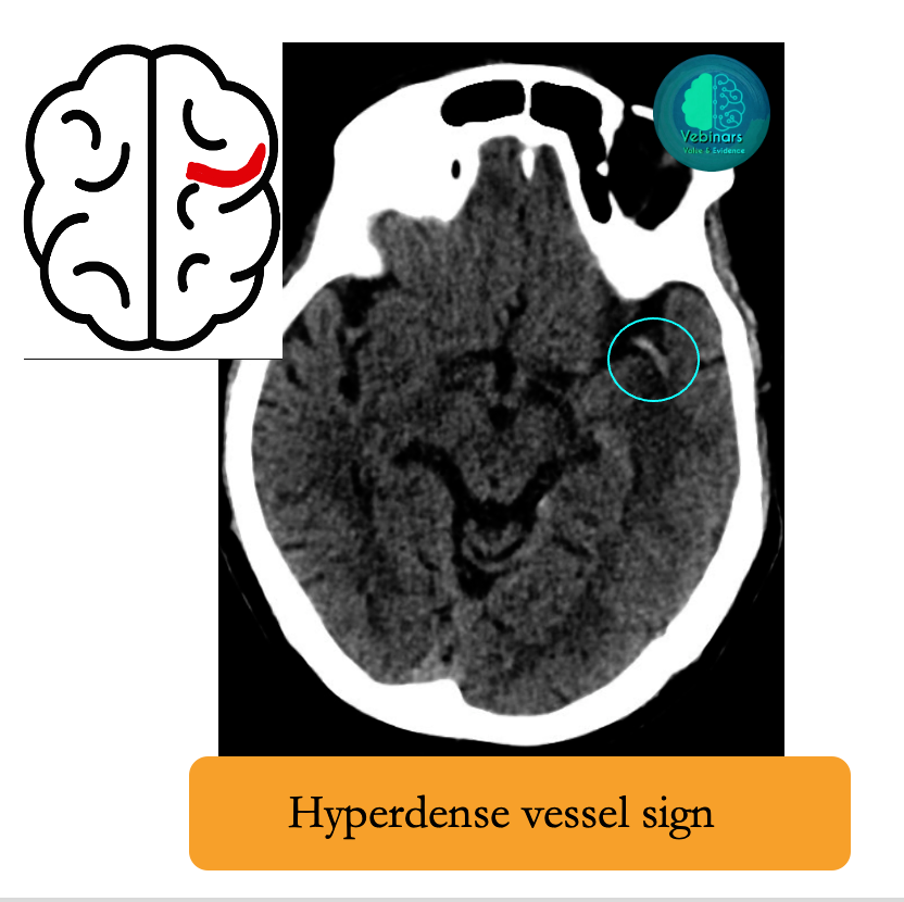 vebinars_neuro's tweet photo. #Hyperdense vessel sign https://t.co/uNFkeR5Lmr