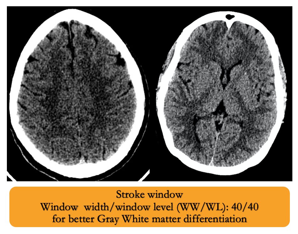 vebinars_neuro's tweet photo. ❗️❗️Pitfalls for CT stroke signs

Use the stroke window settings for better delineation  of grey-white matter differentiation

#vebinars #value_based_imaging #evidence_based_medicine #NeuroRad #Neurology #stroke #FOAMrad #FOAMed #neurotwitter #MedEd  #emergencymedicine https://t.co/x4z0KnTCFc