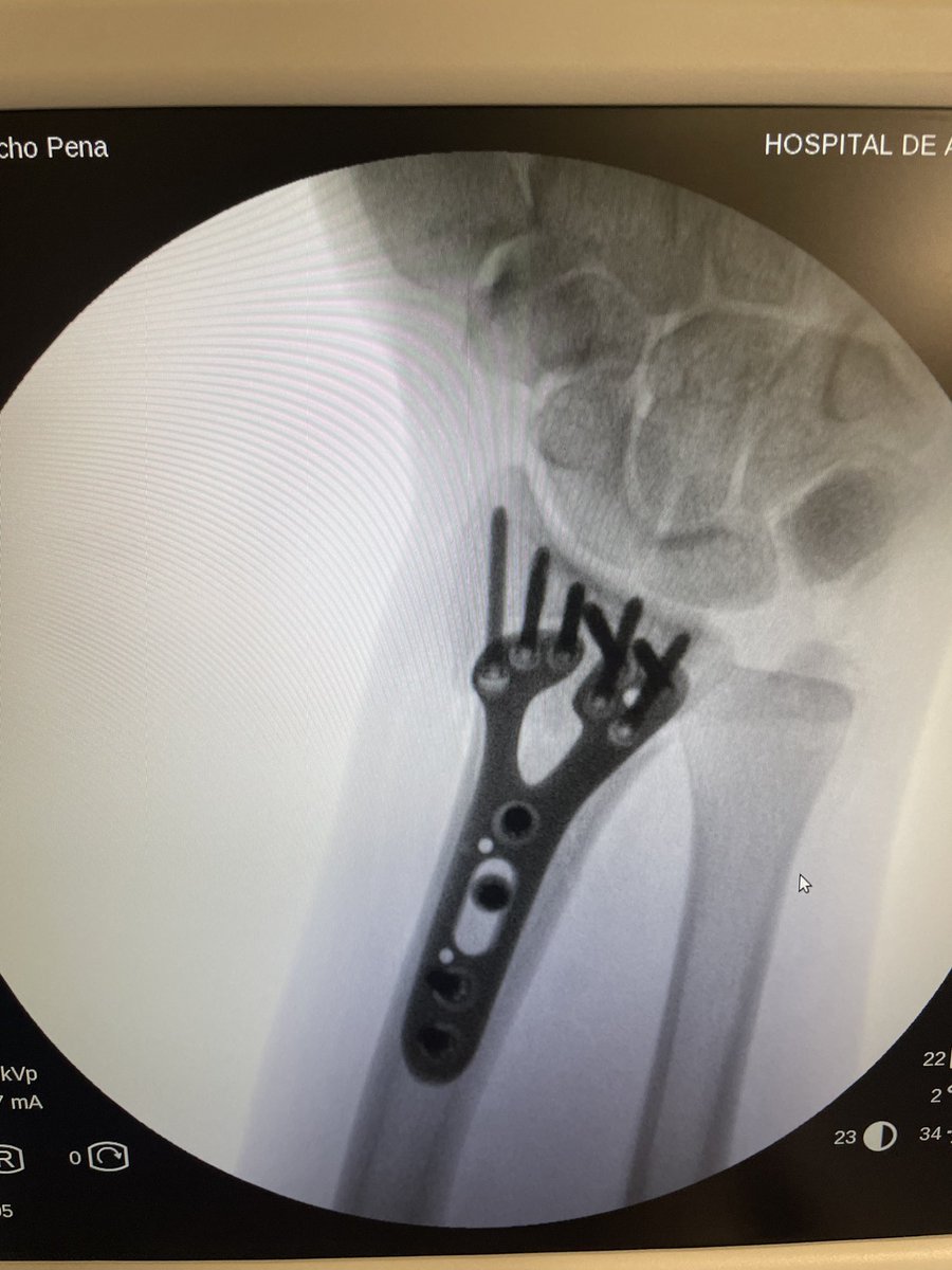 Always check neurovascular status after distal radius fracture. Here we can see an open fracture and ulnar affection. It is important to check before and after reduction, neurovascular problems. An ulnar nerve injury grade II-III  axonotmesis. Always fix and check