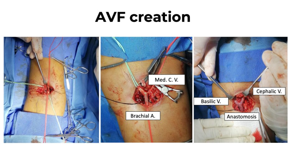 Omar Sánchez Vázquez (@omar_snchezv) on Twitter photo 🚨 Tweetorial alert 💉
50 y/o female with PKD who underwent a bilateral nephrectomy due to profuse bleeding. She had to start urgent HD through a non-tunneled CVC.
She underwent an AVF creation.
#InterventionalNephrology
<a href="/bernardo_moguel/">Bernardo Moguel-Gonzalez</a> <a href="/ISNkidneycare/">Int Society of Nephrology</a> <a href="/brendacfl/">Brenda Cortez</a> <a href="/NefrologiaINC/">Nefrología INC</a> 🚨 Tweetorial alert 💉
50 y/o female with PKD who underwent a bilateral nephrectomy due to profuse bleeding. She had to start urgent HD through a non-tunneled CVC.
She underwent an AVF creation.
#InterventionalNephrology
<a href="/bernardo_moguel/">Bernardo Moguel-Gonzalez</a> <a href="/ISNkidneycare/">Int Society of Nephrology</a> <a href="/brendacfl/">Brenda Cortez</a> <a href="/NefrologiaINC/">Nefrología INC</a>