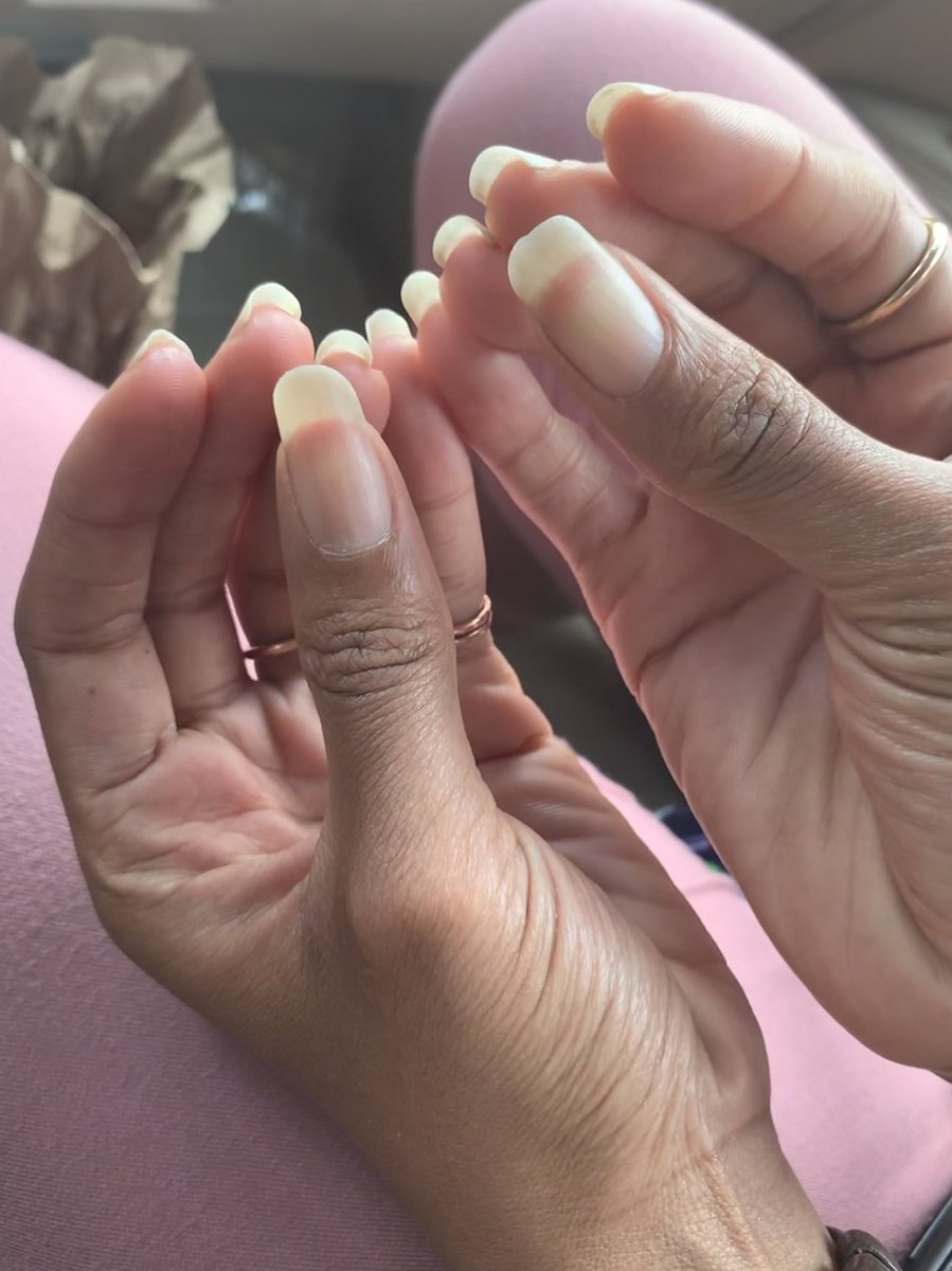 Natural_Nailss's tweet photo. @trudicakes
#naturalnailfactory #barenails #nakednails #naturalnails #longnailbeds #prettyhands #handjewelry #nailpics https://t.co/9nYiaF4c6d