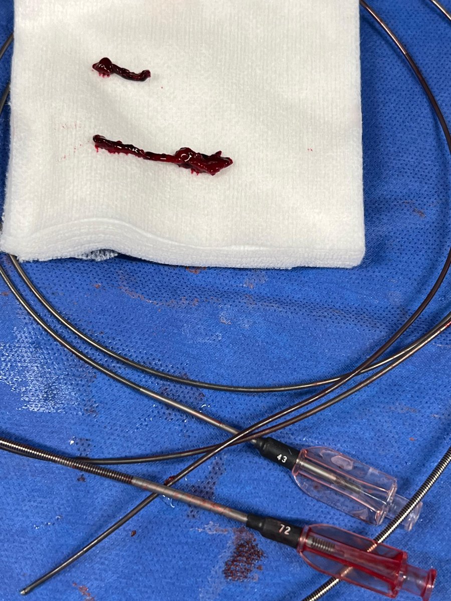 PenNeuro's tweet image. US HCPs: Dr. Kaminsky uses #RED43 with #RED72 to achieve recanalization, in this case, out of Aurora, CO! Rx only. For risk info: bit.ly/2BYj7Yj Clinical results may vary.