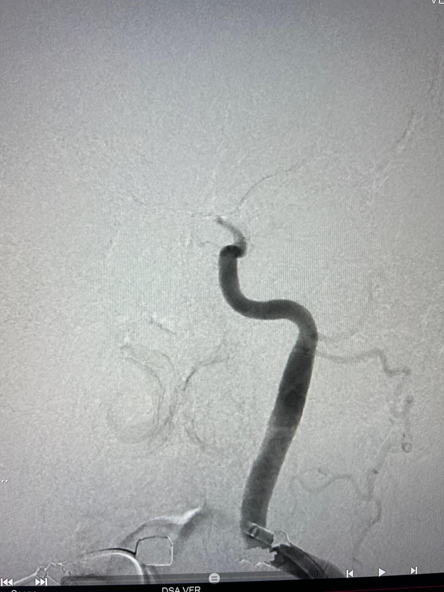 PenNeuro's tweet image. US HCPs: Dr. Kaminsky uses #RED43 with #RED72 to achieve recanalization, in this case, out of Aurora, CO! Rx only. For risk info: bit.ly/2BYj7Yj Clinical results may vary.