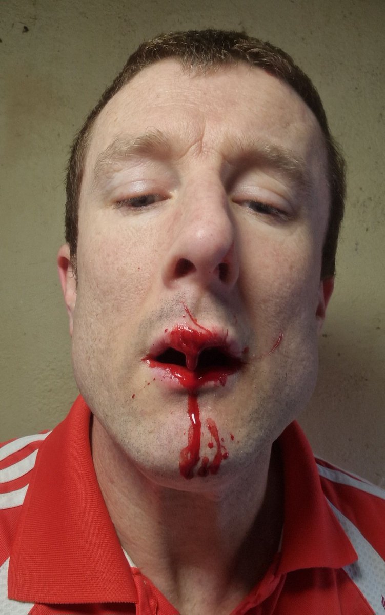 buff_egan's tweet photo. I got an awful fall. I Fell and hit a Rock 😔 https://t.co/0F7h0rYMxy