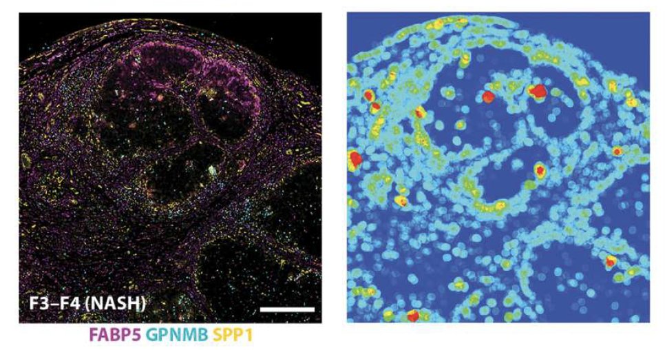 Fab5 macrophages localized at the edge of the scar, are enriched in lung and liver fibrosis across species. We then identified that type 3 cytokines IL17A, GMCSF and TGFb contribute to this phenotype. Therapeutic inhibition of these cytokines reduced  Fab5 % and fibrosis. 5/? 🧵