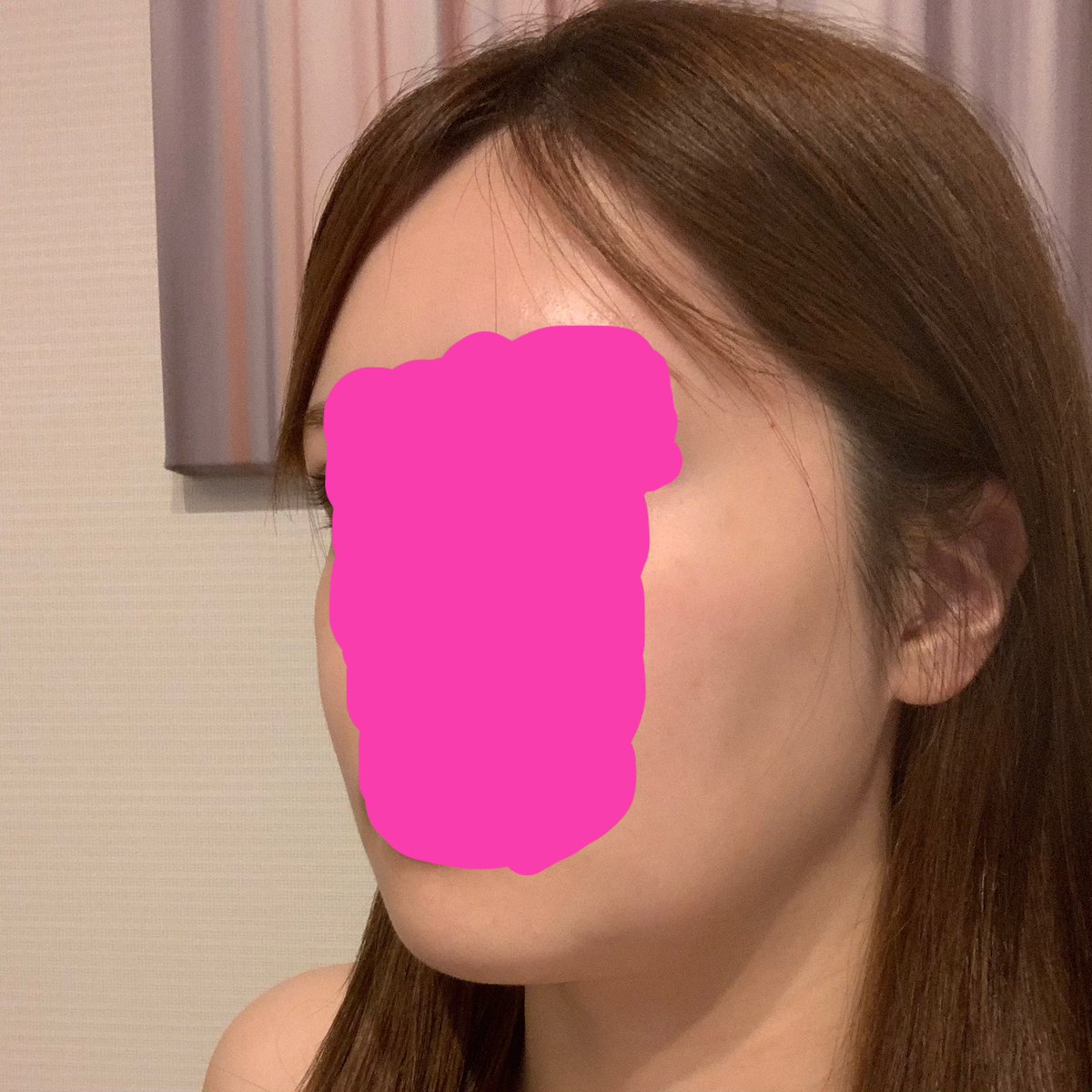 0302rk3's tweet photo. 輪郭3点 DT1か月半
まだ口周りのもたつきや口の開けにくさはありますが、かなり腫れが引いた気がします✨️ 開口は指2本ギリギリ開かないくらい！時間が経って脂肪が下に落ちてきたのか皮膚が落ちてきたのか、こう見ると少し頬下が凹んでいるように見えるので早くリフトで上げたいです😣😣でも→ https://t.co/ZRSVlUMcVI