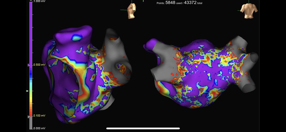 kylem80441's tweet photo. Case # 1 of our Abbott AF Experience program at University of Maryland Medical Center! Pre and post voltage collected with Advisor HD Grid, ablation with TactiCath SE. First pass isolation achieved on left and right PV’s. Great work Maryland team! https://t.co/ru6h1fQrDt