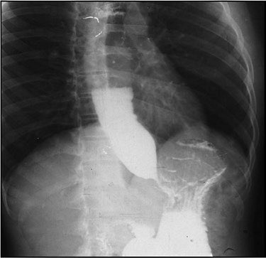 Patient with an unexplained swollen eye during childhood presents with dysphagia 20 years later. What’s the diagnosis?