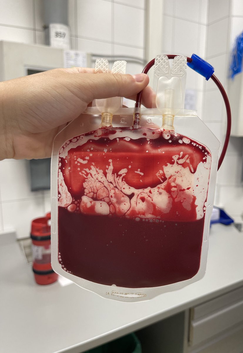 enferactive's tweet photo. Esto de aquí es una bolsa de hematíes 🩸 fraccionada para un bebé de 3 días.

Cuando se necesita transfundir pequeñas cantidades de sangre, se fracciona la bolsa madre (250-300ml) en 2,3 e incluso 4 bolsas más pequeñas (también llamadas satélites) para no desperdiciar nada. https://t.co/IwfkTdIOUU