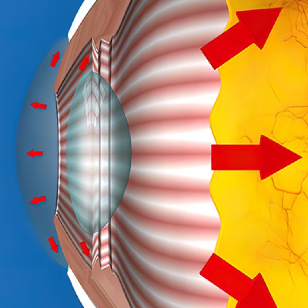 Glaucoma is an eye disease that causes progressive damage to the optic nerve resulting in vision loss. Learn more here: bit.ly/3KTWJ2M