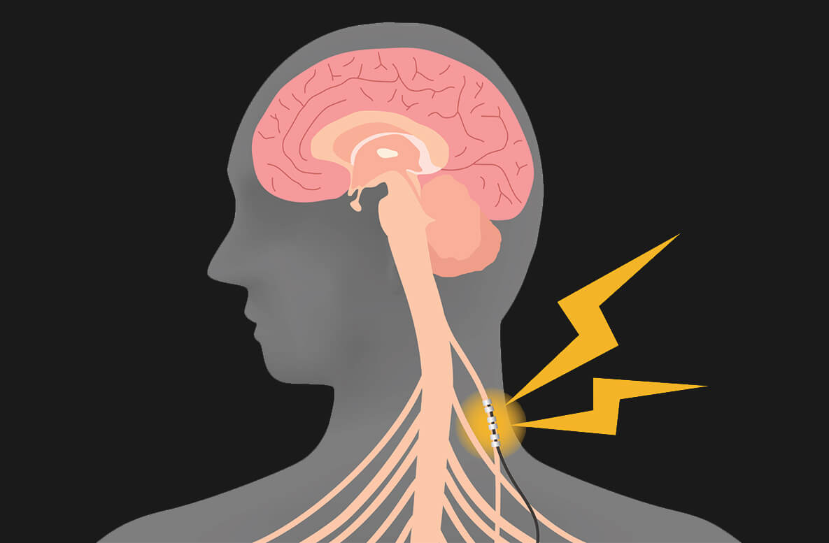 Considering trying #VagusNerveStimulation? We answer common questions about this unique treatment: bit.ly/3oc9oVV

#Epilepsy #Depression #Headache #Migraine